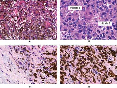 Electrochemotherapy as a Trigger to Overcome Primary Resistance to Anti-PD-1 Treatment: A Case Report of Melanoma of the Scalp